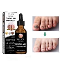 [당일배송] EELHOE 발톱무좀 네일 리페어 에센스 톱 발톱강화 손톱 영양제 발톱 무좀약, 50ml