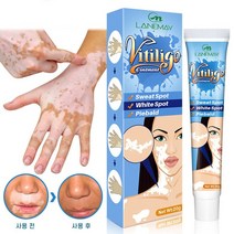 BT 백반증 치료 연고 손 목 몸 얼굴 연피부 백반증치료, 20g, 2개