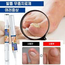 발톱무좀치료 발톱무좀약 손발톱 네일 리페어 강화 에센스, 3ml, 3개