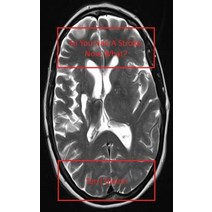 So You Had a Stroke: Now What? Paperback, Createspace Independent Publishing Platform