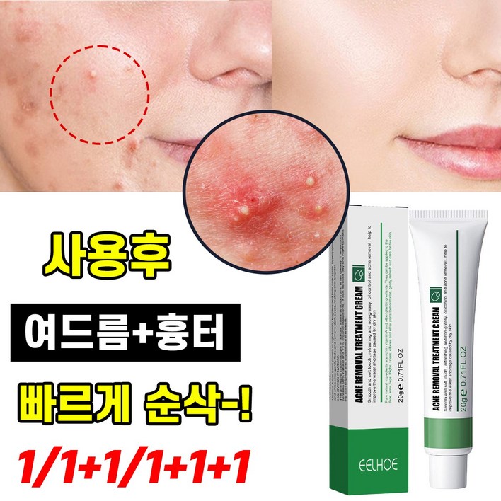 1/1+1/1+1+1 여드름흉터연고 색소침착 미백크림 얼굴 리페어크림 여드름제거