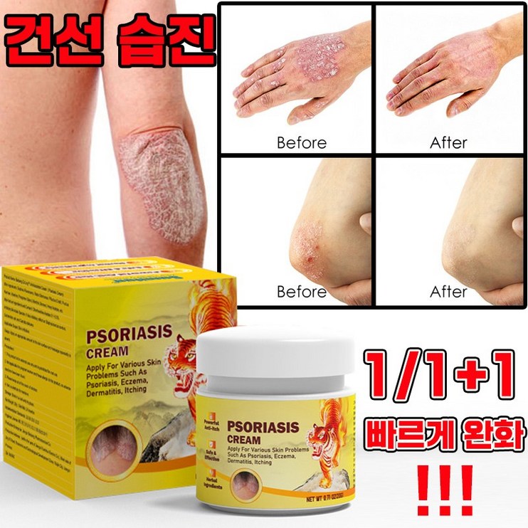 빨른 배송 미국 건선 연고 치료제 두드러기 가려움 연고 피부 가려움증 허브 크림 빨른 배송 미국 건선 연고 치료제 두드러기 가려움 연고 피부 가려움증 허브 크림